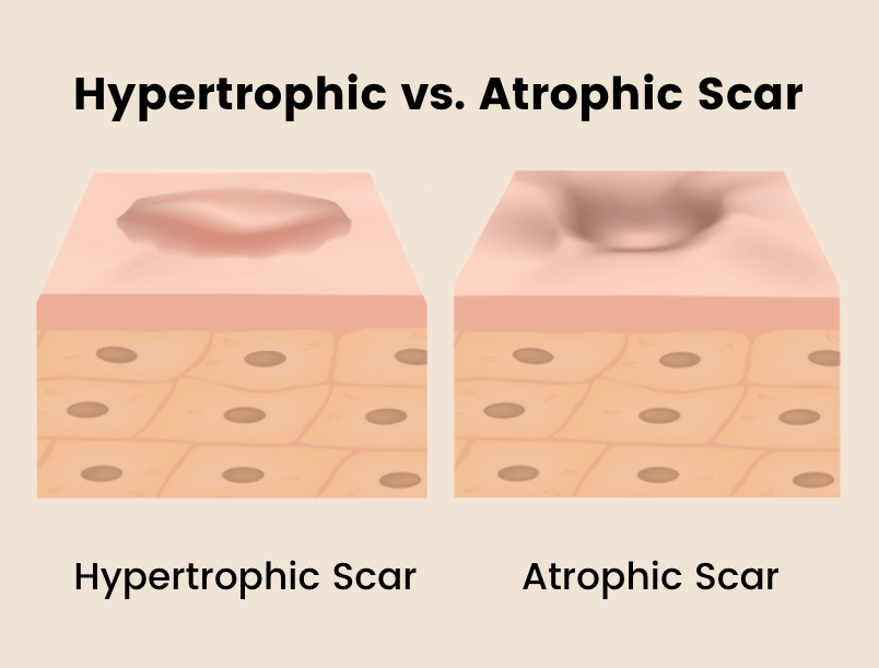 Hypertrophic vs Atrophic Acne Scars